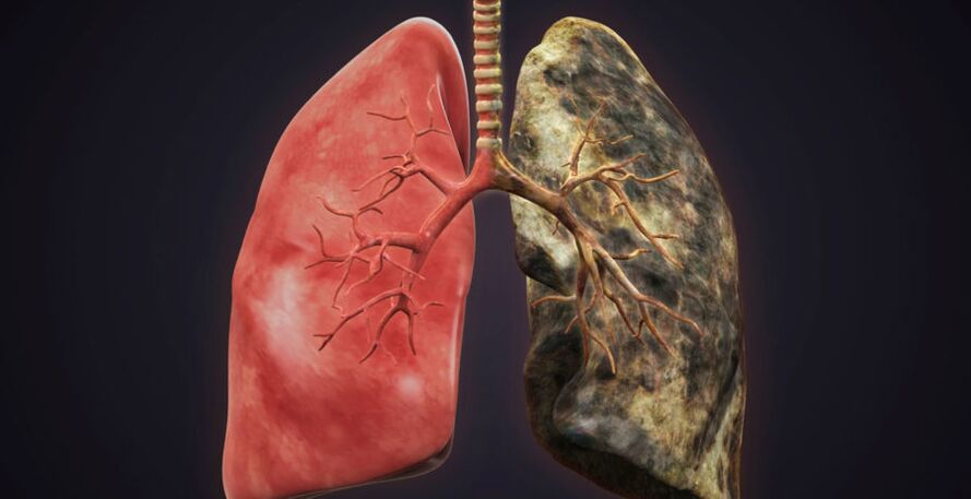 pluća pušača i prestanite pušiti
